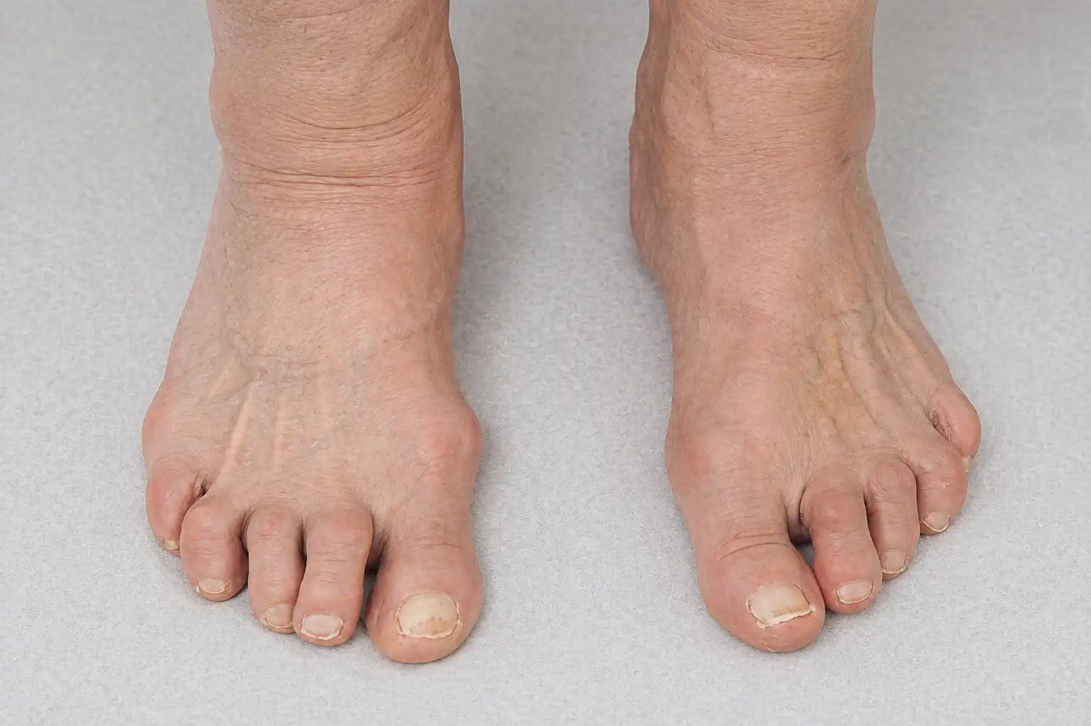 The Quiet Pain of Arthritis in Feet That Slowly Steals Your Mobility