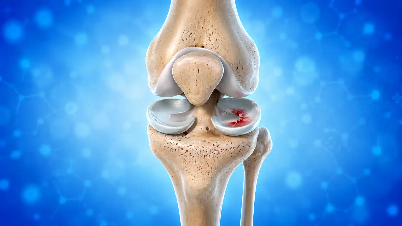 Common Causes of Meniscus Tear Knee Injuries in Sports and Everyday Activities