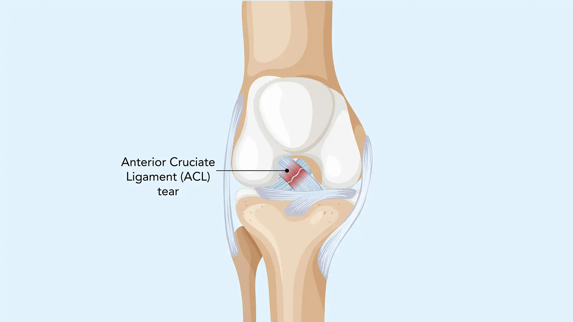 What Is ACL Surgery & Why Do So Many People End Up Needing It