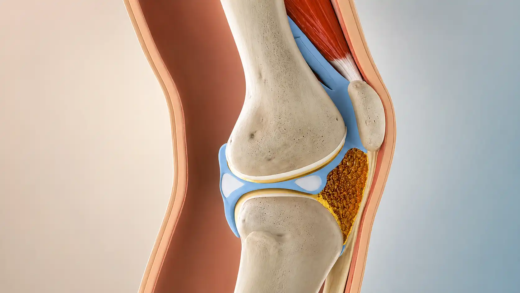Arthrofibrosis, Why Your Knee Is Still Stiff After Surgery