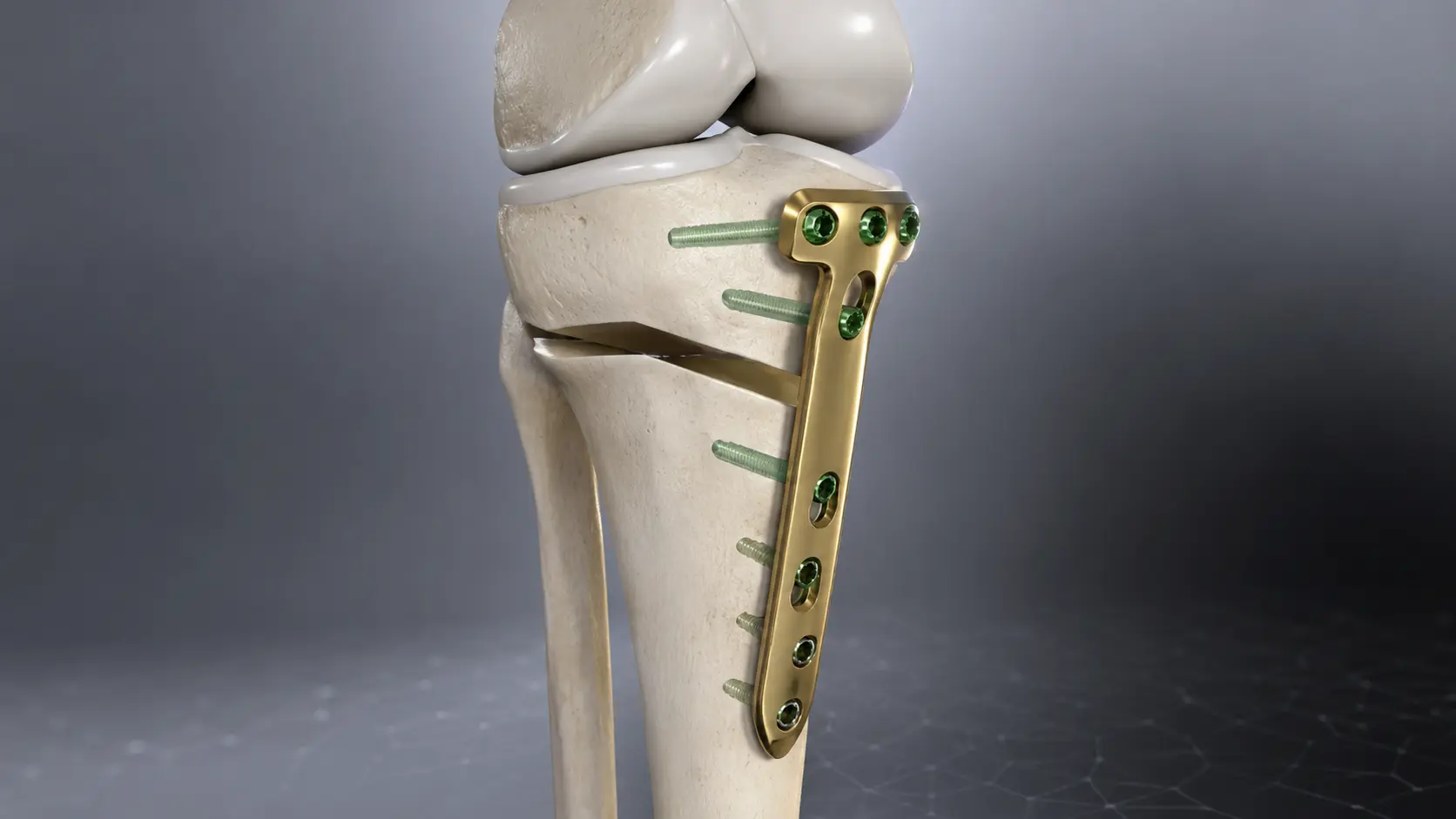 What Is High Tibial Osteotomy and Is It the Right Option for Your Knee 