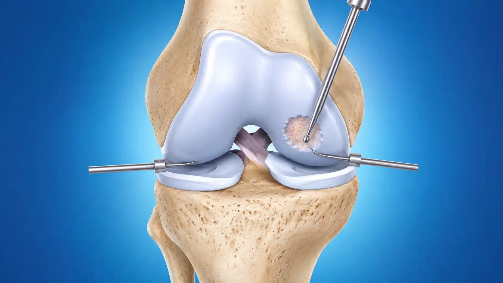 Does Knee Surgery for Cartilage Guarantee Pain Relief