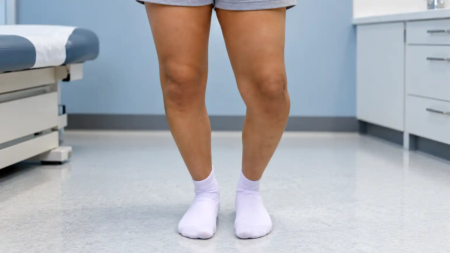 Blount’s Disease or Bow Legs? How to Tell the Difference