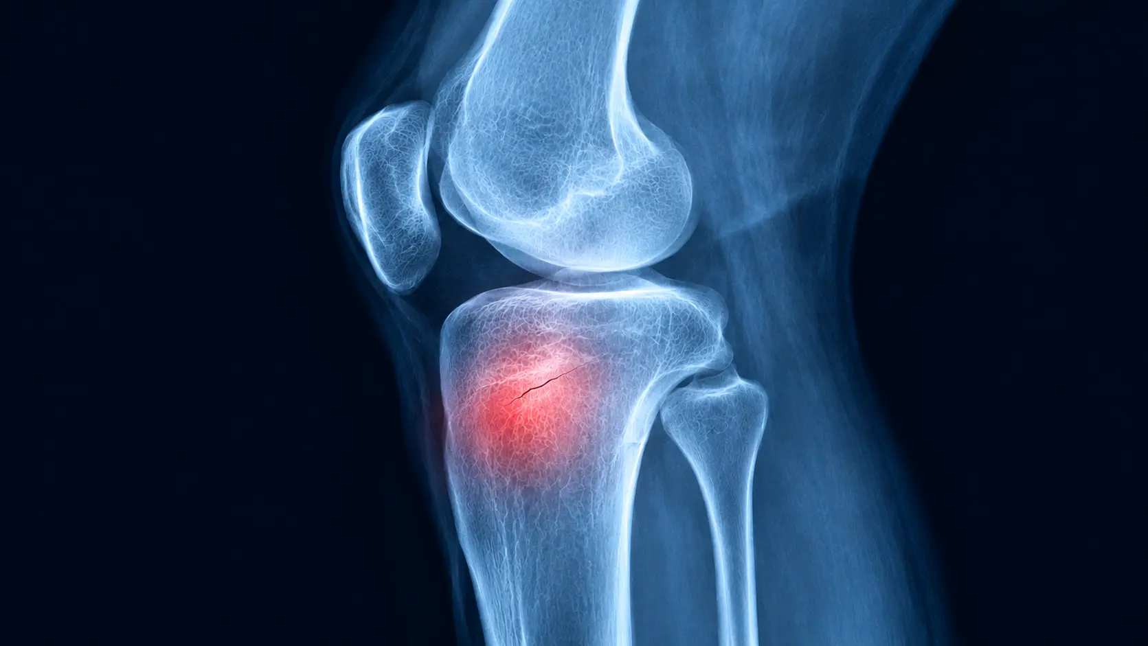Knee Pain Not Settling? It Could Be a Knee Stress Fracture