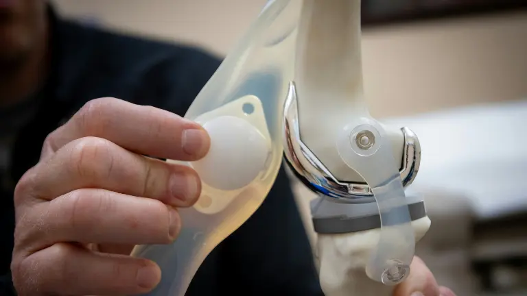 Knee Osteotomy vs Knee Replacement: How Surgeons Decide Which Is Right for You?