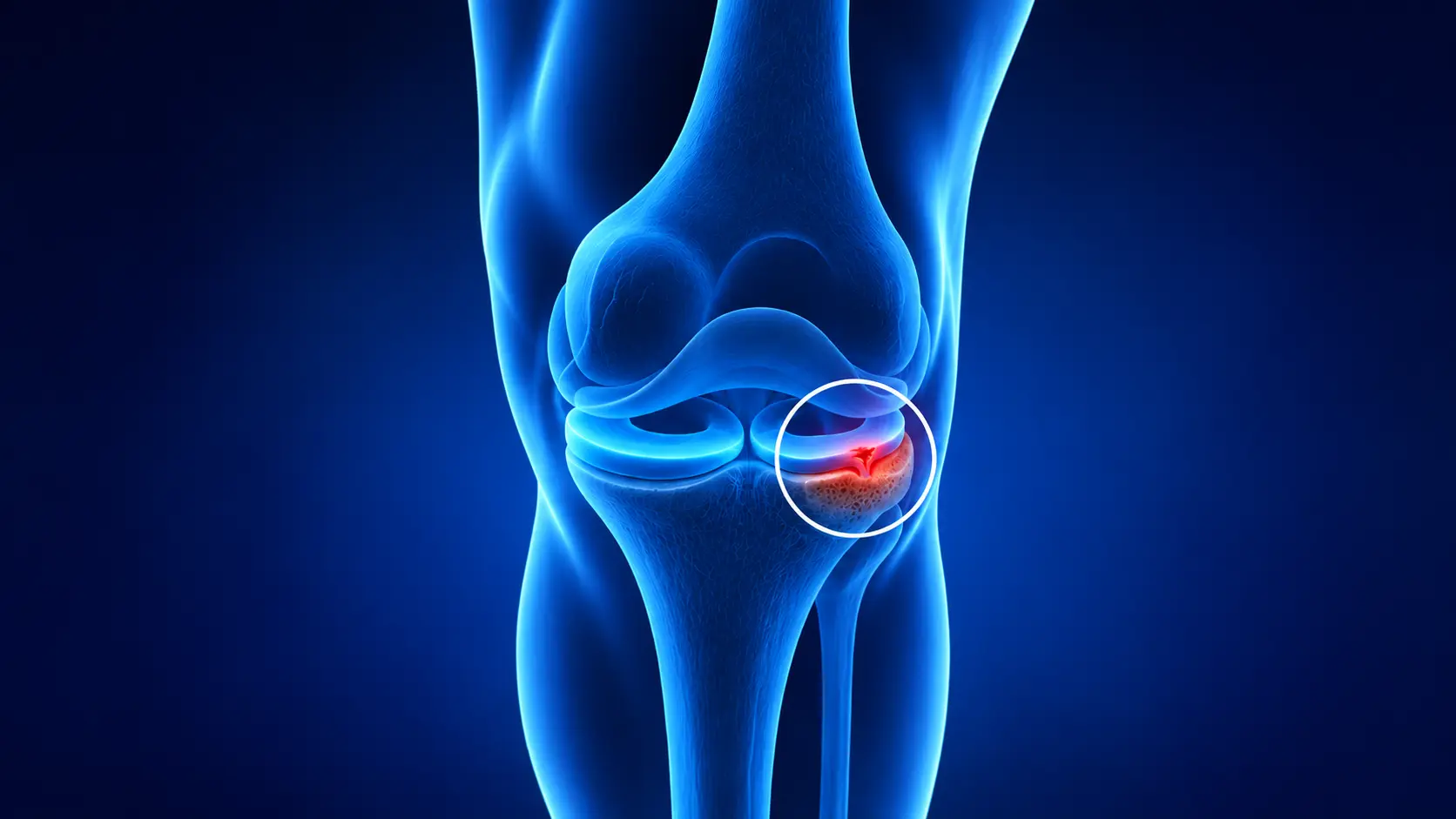 Meniscal Root Tear: Symptoms, Treatment and Recovery